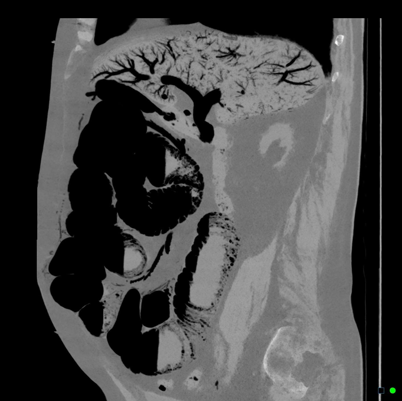 Portal Venous Gas Due To Small Bowel Infarction Image