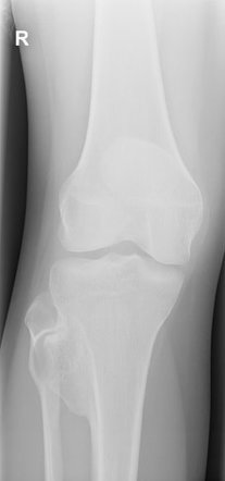 Osteochondroma | Radiology Case | Radiopaedia.org