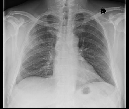 Right upper lobe pneumonia | Radiology Case | Radiopaedia.org