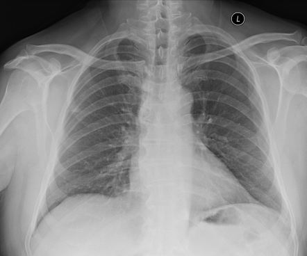 Right upper lobe pneumonia | Image | Radiopaedia.org