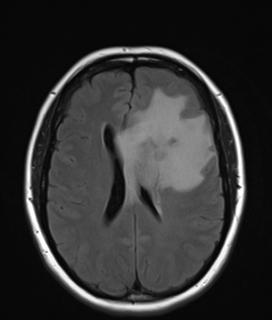 Inflammatory demyelination | Image | Radiopaedia.org