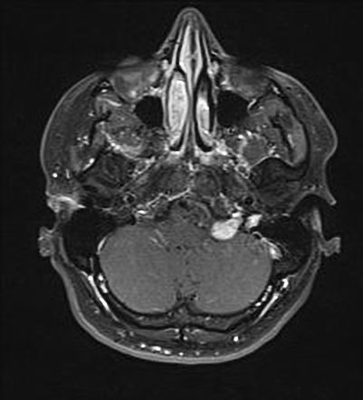 Jugular foramen schwannoma | Radiology Reference Article | Radiopaedia.org