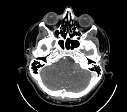 Jugular foramen schwannoma | Image | Radiopaedia.org