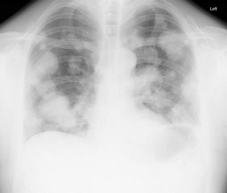 cannonball metastases lungs radiopaedia radiology carcinoma renal bladder