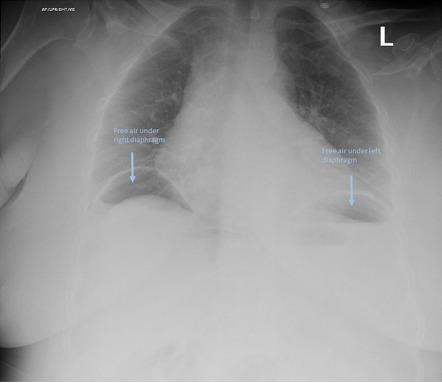 Pneumoperitoneum | Image | Radiopaedia.org