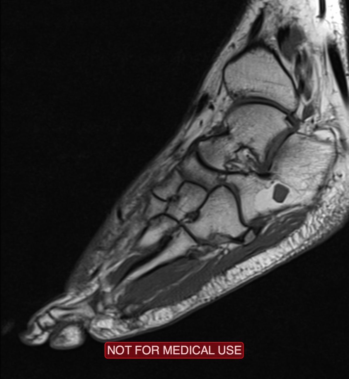 Chemical shift artifact in involuting calcaneal lipoma | Image ...