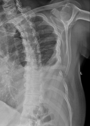 Xrays Of Broken Ribs