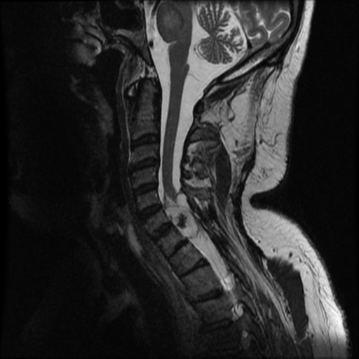 Osteochondroma - spine | Image | Radiopaedia.org