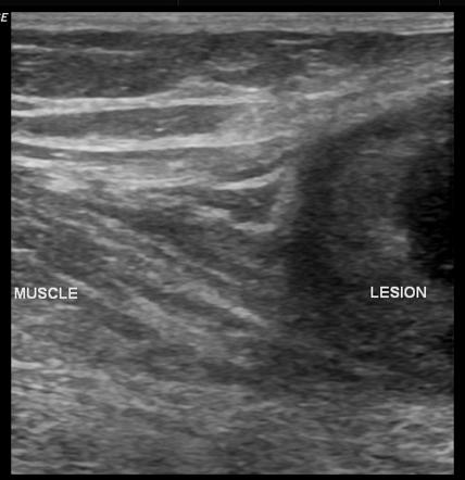 Myosarcoma - thigh | Image | Radiopaedia.org