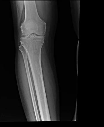 Chondrocalcinosis 