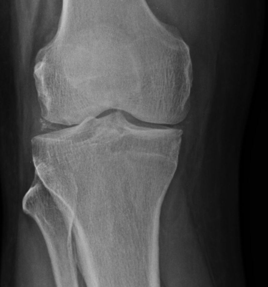 Chondrocalcinosis | Image | Radiopaedia.org