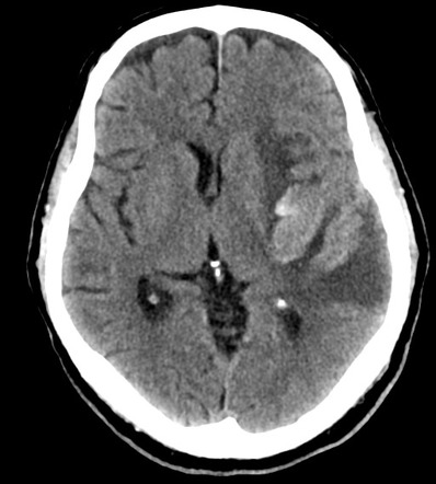 Hemorrhagic infarct with T2 blackout | Radiology Case | Radiopaedia.org