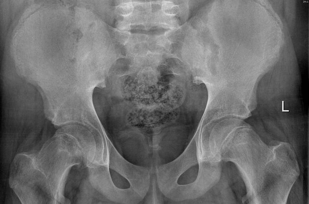 Slipped Capital Femoral Epiphysis Radiology