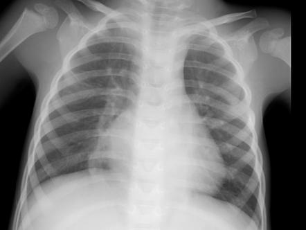 Scimitar syndrome (lungs) | Radiology Reference Article | Radiopaedia.org