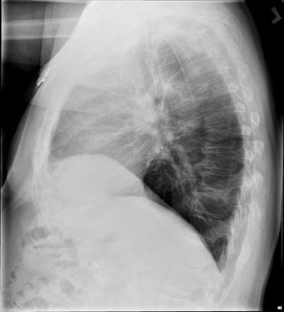 Phrenic nerve stimulator | Image | Radiopaedia.org