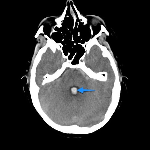 The subarachnoid hemorrhage (SAH) stages. The yellow arrows