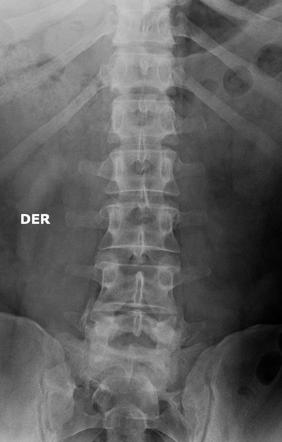 L5/S1 spondylolisthesis | Radiology Case | Radiopaedia.org