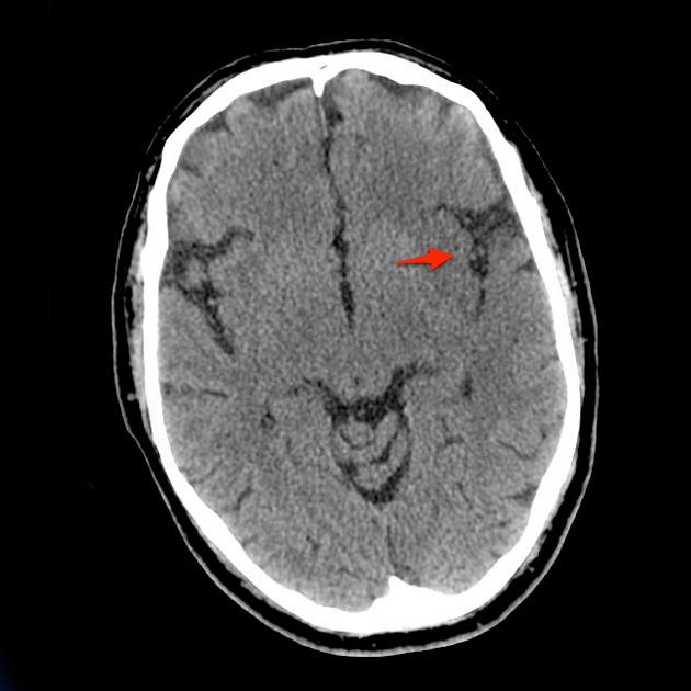 Acute MCA territory infarct | Image | Radiopaedia.org