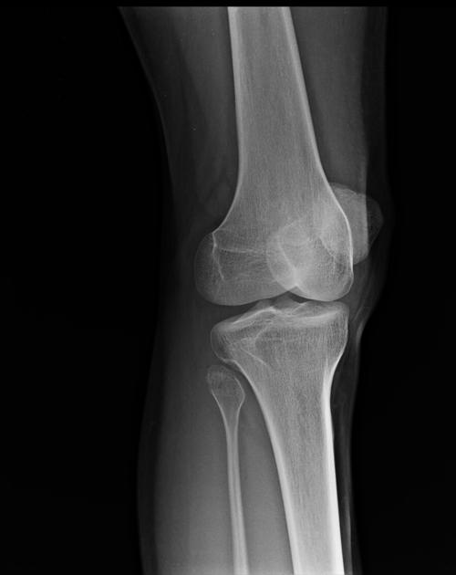 Knee oblique view Radiology Reference Article Radiopaedia