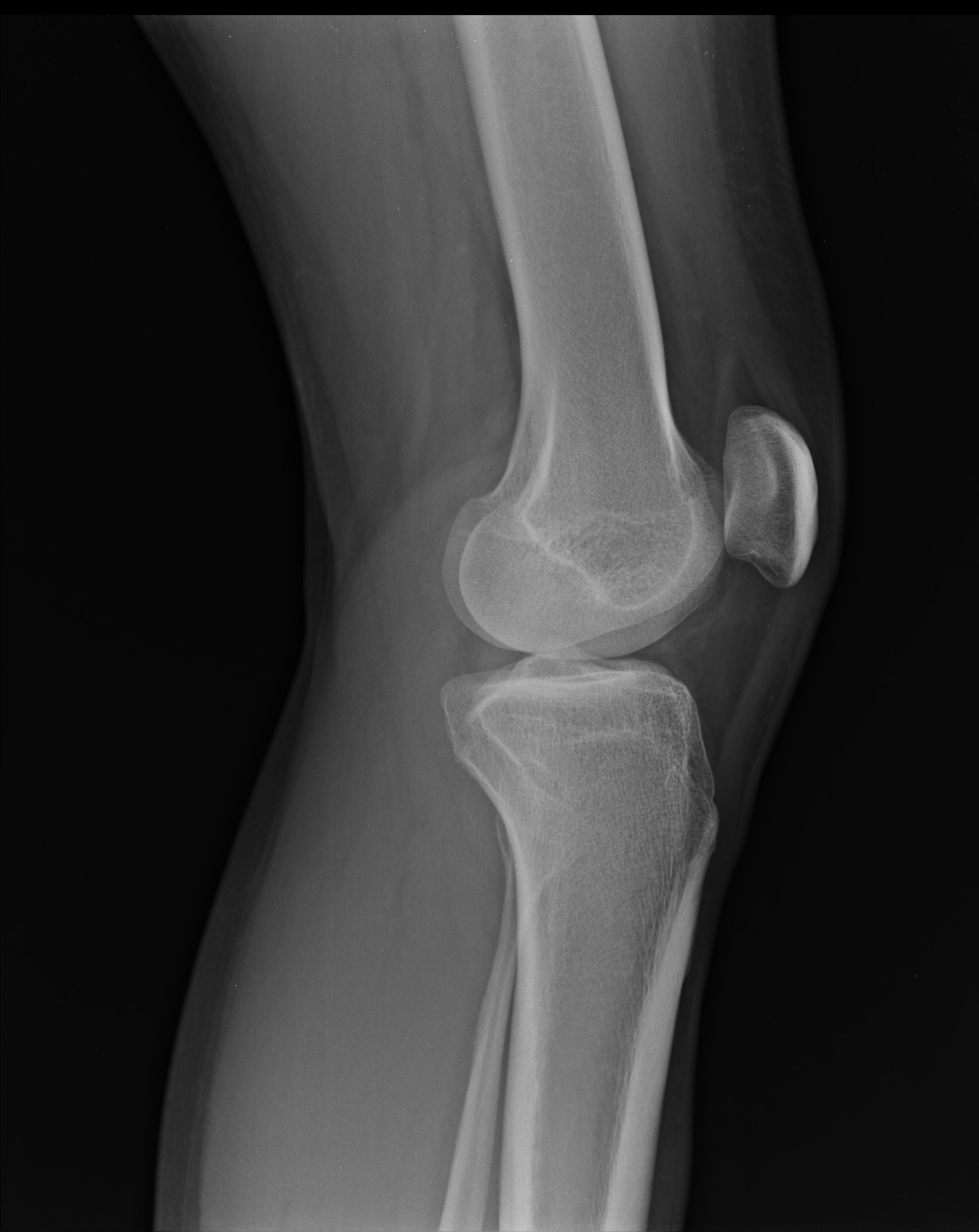 Fibular Head Fracture Image