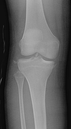 Multiple avulsion fractures: knee | Radiology Case | Radiopaedia.org