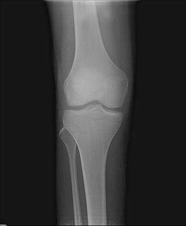 Patellar tendon avulsion from tibial tuberosity | Radiology Case ...