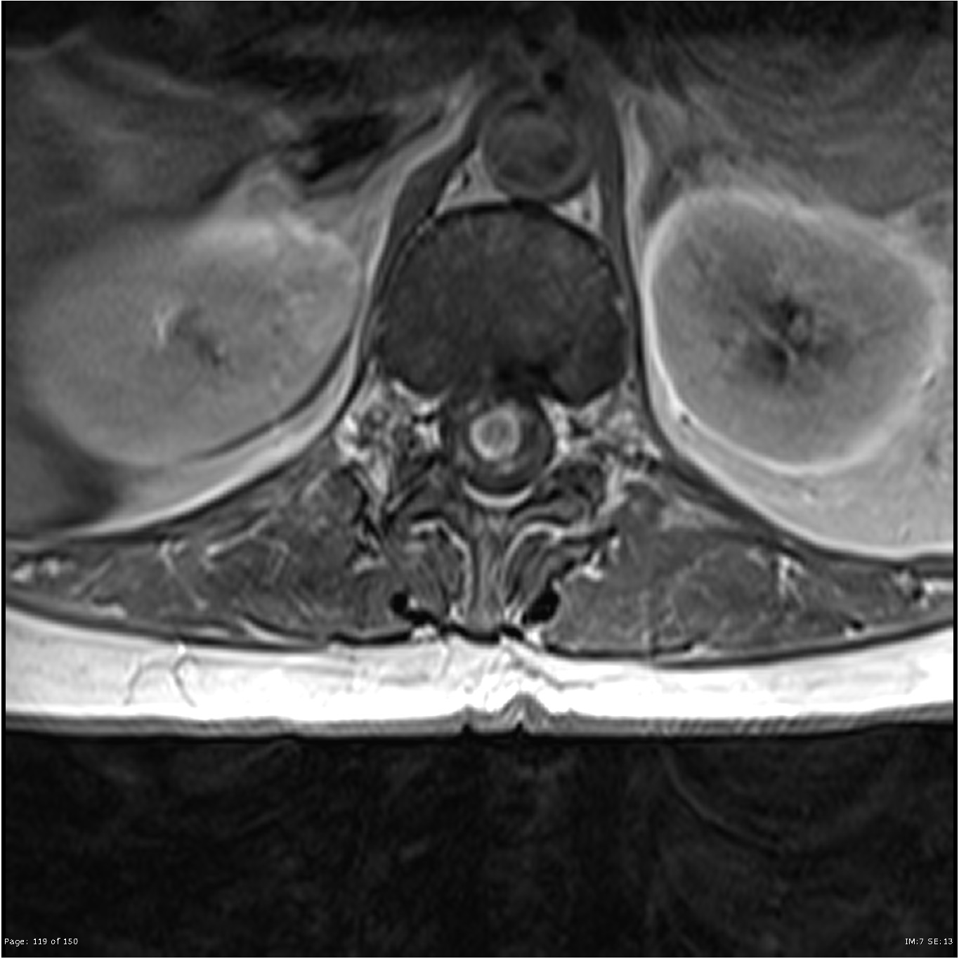 Spinal cord metastasis | Image | Radiopaedia.org