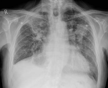 Progressive massive fibrosis | Radiology Reference Article ...