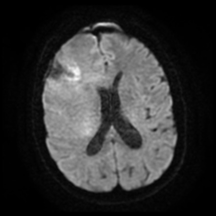 Glioblastoma IDH wild-type (with pseudoprogression) | Image ...