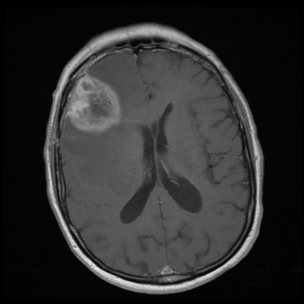 Glioblastoma IDH wild-type (with pseudoprogression) | Image ...