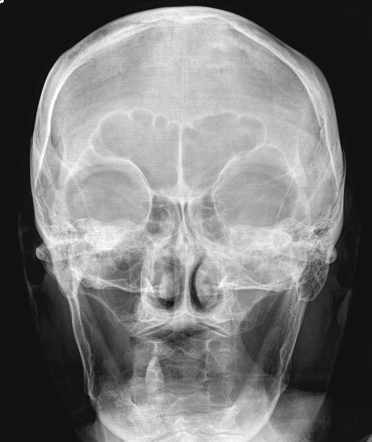 Biparietal osteodystrophy | Image | Radiopaedia.org