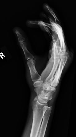 Hamate fracture | Image | Radiopaedia.org