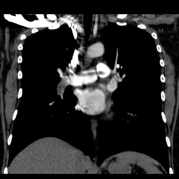 Saddle Pulmonary Embolism Image 8610