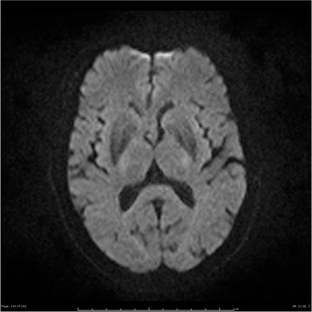 Subependymoma 