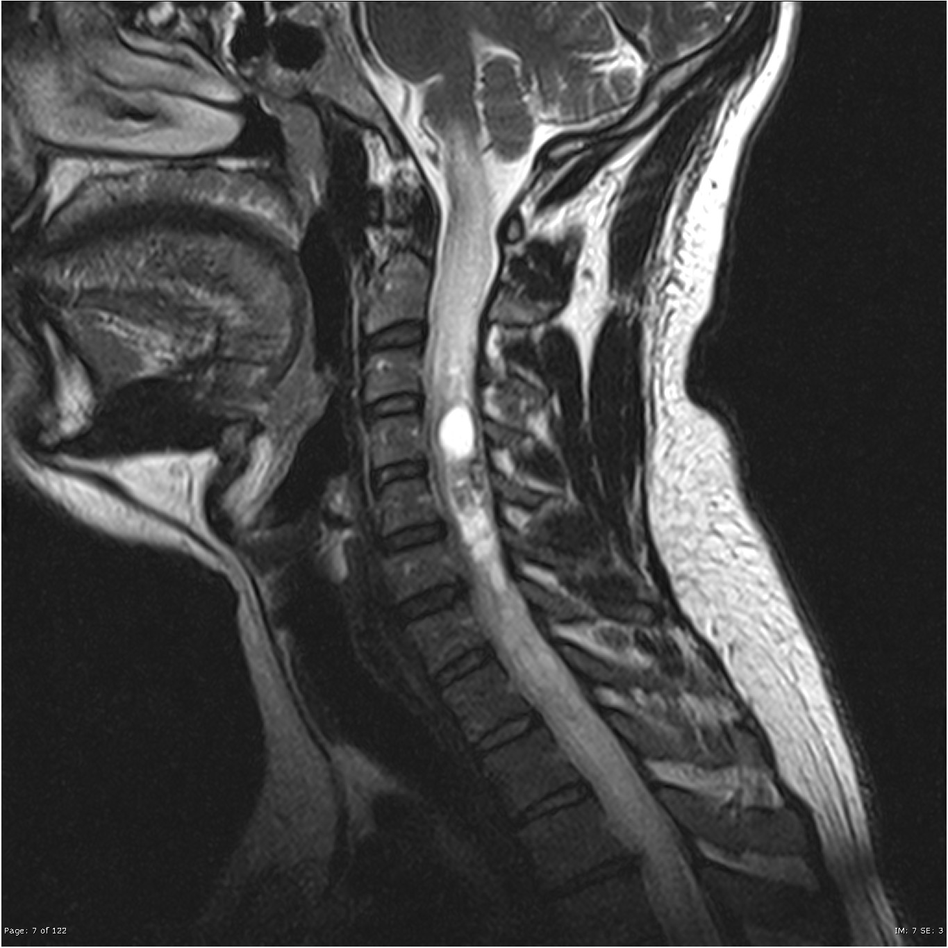 Интрамедуллярные опухоли спинного мозга ,снимок мрт