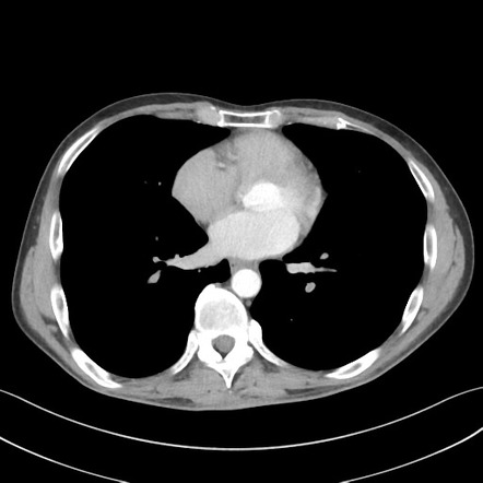 Apical pleural calcification | Image | Radiopaedia.org