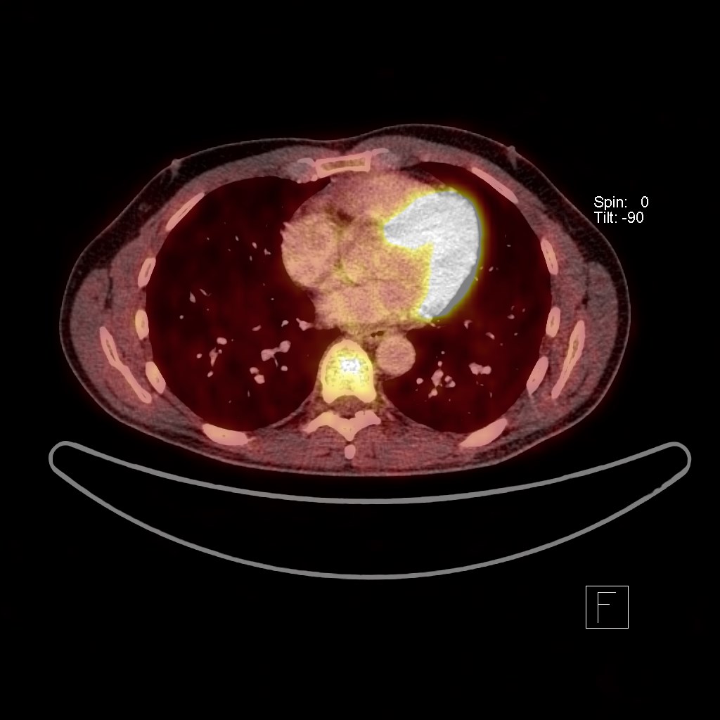 Pulmonary cryptococcosis | Image | Radiopaedia.org