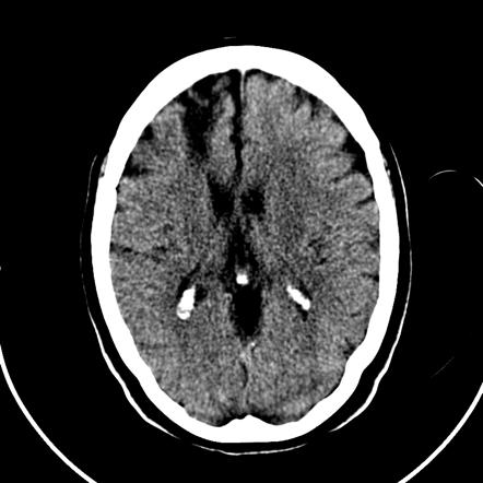 Watershed cerebral infarction | Radiology Reference Article ...