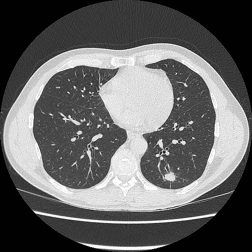 Pulmonary cryptococcosis | Image | Radiopaedia.org