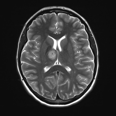 Tumefactive demyelinating lesion: thalamic | Radiology Case ...