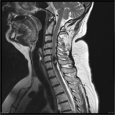 Spinal ependymoma | Radiology Reference Article | Radiopaedia.org