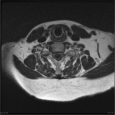 Spinal cavernoma | Image | Radiopaedia.org