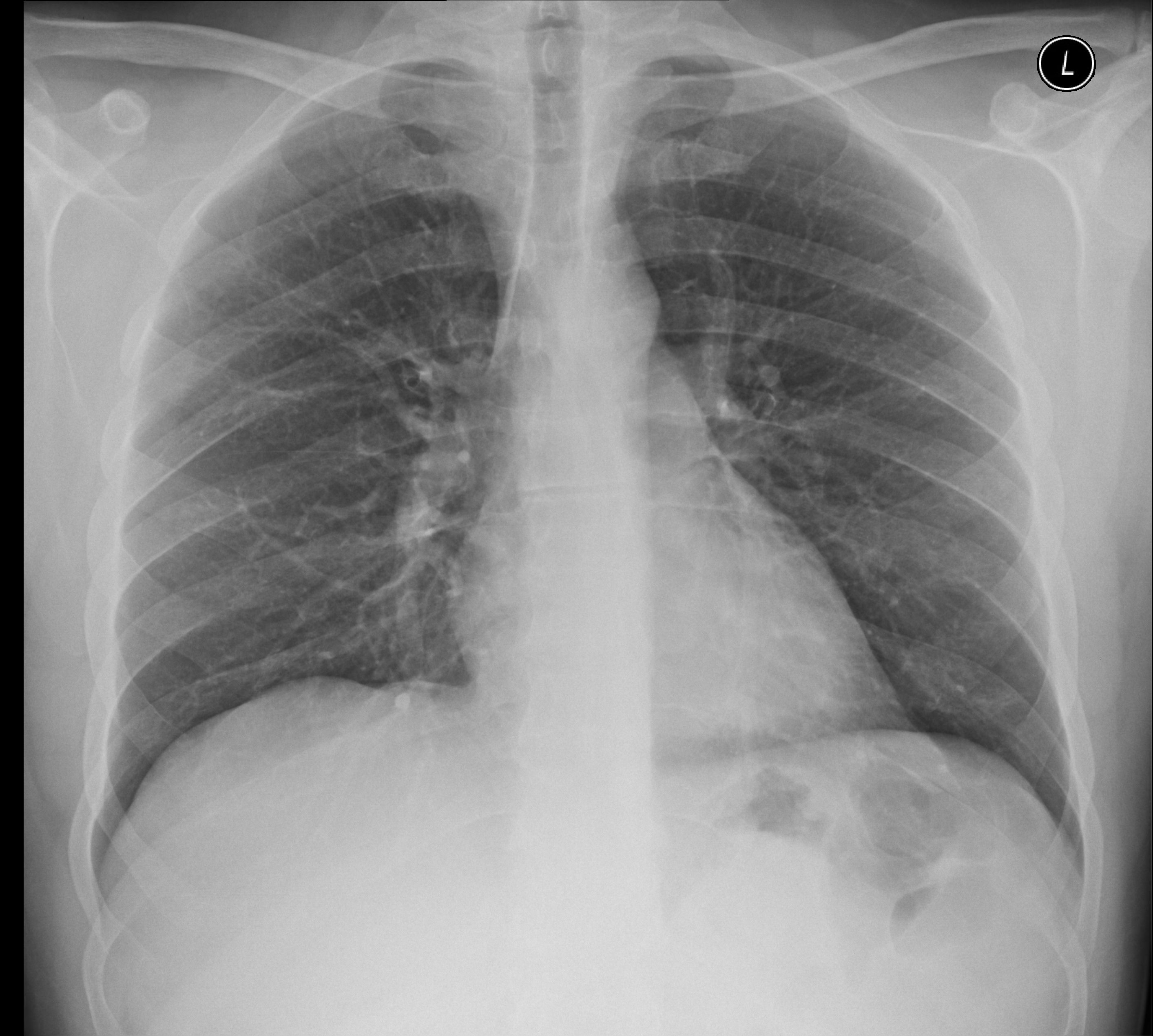 Right middle lobe pneumonia | Image | Radiopaedia.org