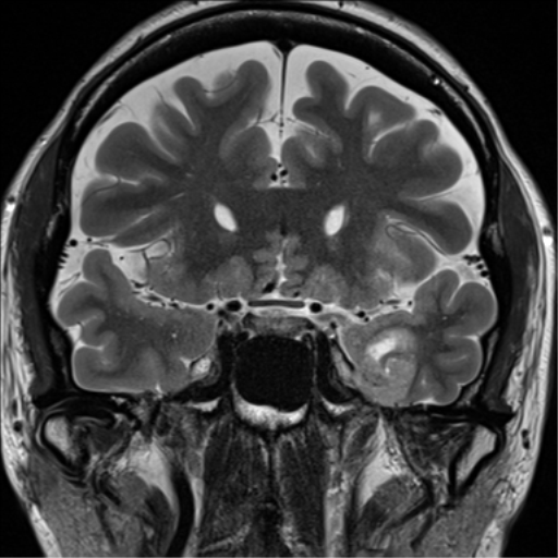 Ganglioglioma | Image | Radiopaedia.org