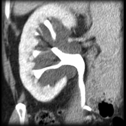 Hydronephrosis | Radiology Reference Article | Radiopaedia.org