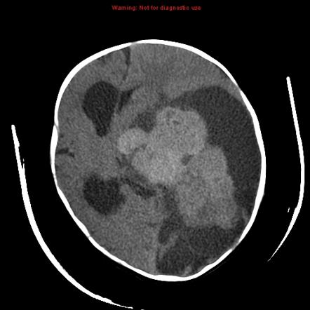 Hemorrhagic intracranial tumors | Radiology Reference Article ...