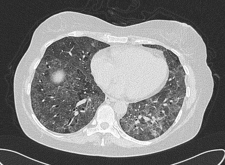 Head cheese sign (lungs) | Radiology Reference Article | Radiopaedia.org