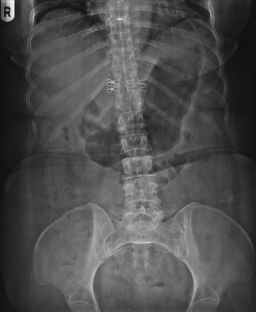 Dermatofibrosarcoma protuberans: lumbar region | Radiology Case ...