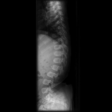 Typical thoracic vertebrae  Radiology Reference Article