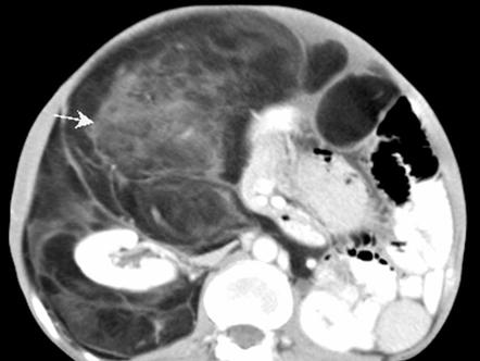 Liposarcoma | Radiology Reference Article | Radiopaedia.org